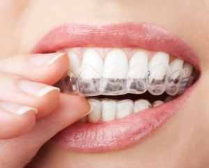 Invisalign in Denver, CO