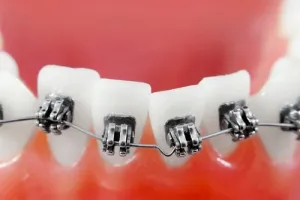 Crooked teeth braces