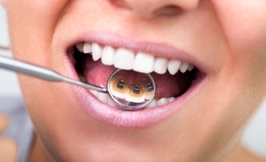 Dentist using mirror to look at Lingual braces