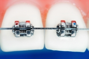 Closeup of teeth with braces hardware