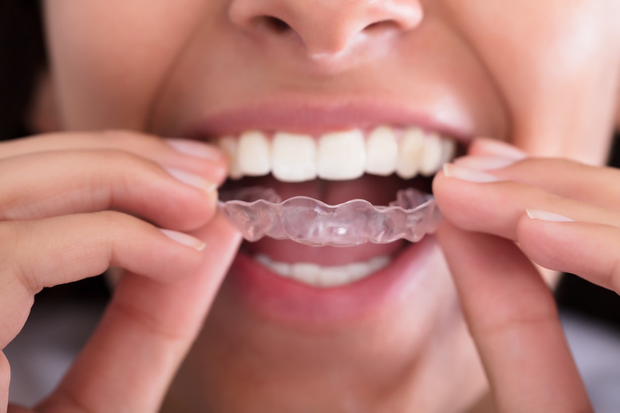 how-long-should-i-keep-my-retainer-in-for-speaks-orthodontics