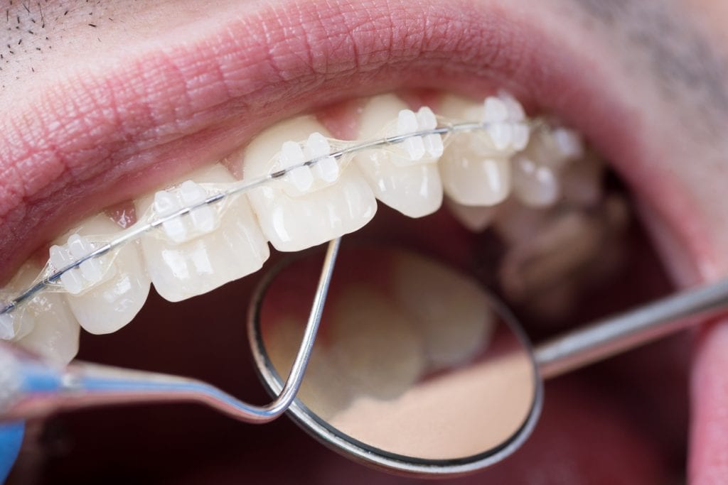 Closeup of teeth with braces