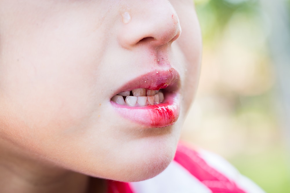 Young girl underbite bloody lip